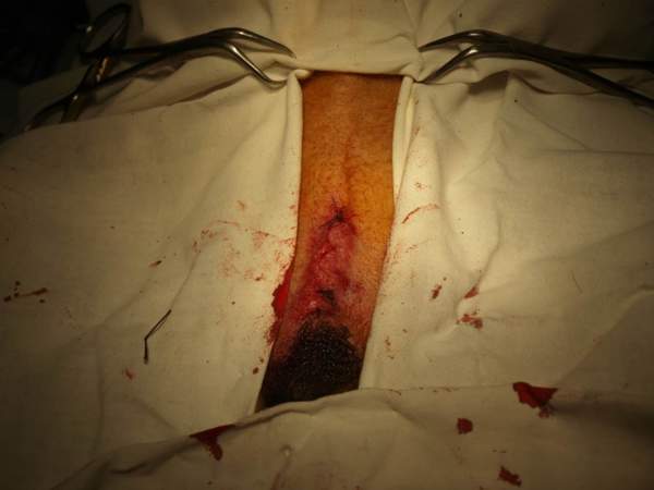 вид операционной раны после наложения швов (операция закончена)